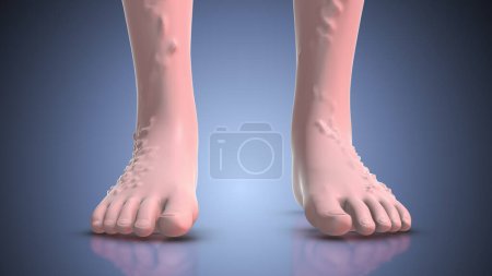 Photo for The concept of human varicose veins. - Royalty Free Image