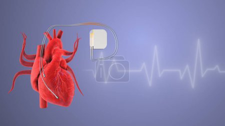 Photo for Cardiac pacemaker heartbeat wave linesrt - Royalty Free Image