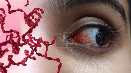 An eye with bacterial purulent conjunctivitis, also known as pink eye