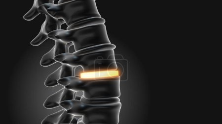 Téléchargez les photos : Implants lombaires Stabiliser la colonne vertébrale - en image libre de droit
