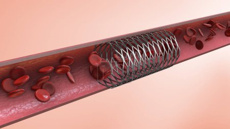 Photo for Implantation of a coronary stent - Royalty Free Image