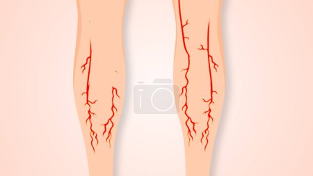 Photo for Concept of vascular disease, varicose veins, and venous insufficiency. - Royalty Free Image