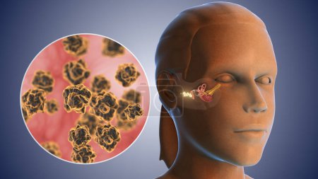 concepto médico de infección bacteriana por cera de oído