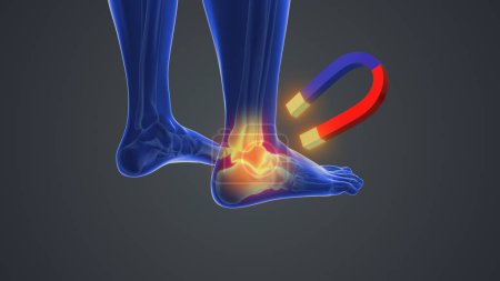 Magnet therapy for feet joint pain