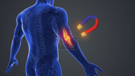Magnet therapy for elbow joint pain