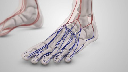 Téléchargez les photos : Lésion des vaisseaux sanguins diabétiques dans les pieds - en image libre de droit
