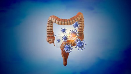 Photo for Medical concept of a large intestinal infection - Royalty Free Image