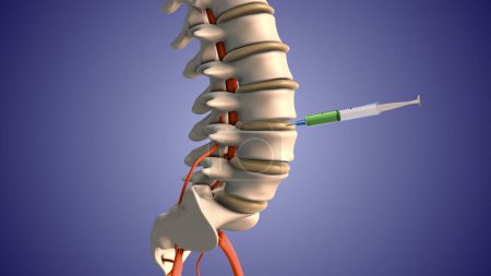 Injecting steroids to treat herniated disc pain