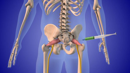 Injecting steroids to treat Piriformis Syndrome