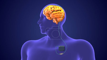 Foto de Concepto médico de estimulación cerebral profunda - Imagen libre de derechos