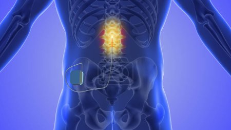 Photo for Spinal cord stimulation medical concept - Royalty Free Image
