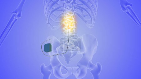 Photo for The medical notion of spinal cord stimulation - Royalty Free Image