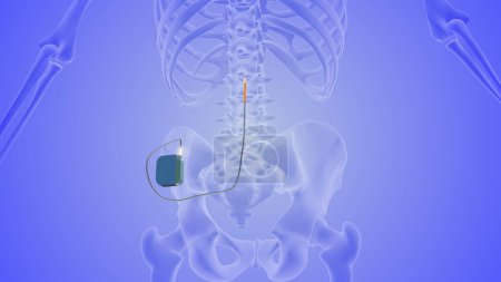 Photo for The medical notion of spinal cord stimulation - Royalty Free Image