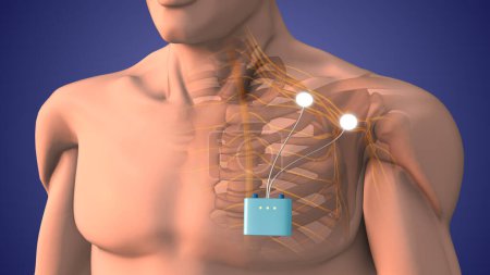 Téléchargez les photos : Thérapie de stimulation nerveuse périphérique dans la région de l'épaule - en image libre de droit