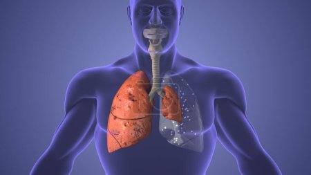 Lungs pneumothorax disease medical concept