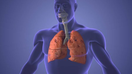 Lungs pneumothorax disease medical concept
