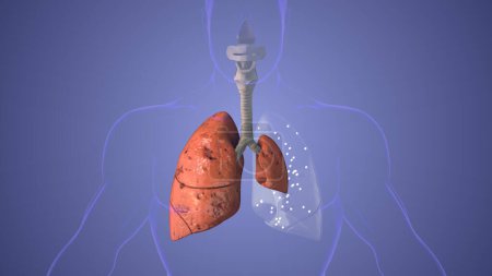 Los pulmones neumotórax enfermedad concepto médico