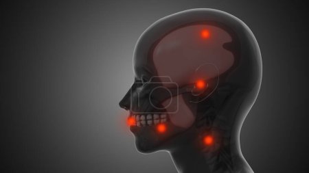 Trigger points and myofascial pain in the TMJ