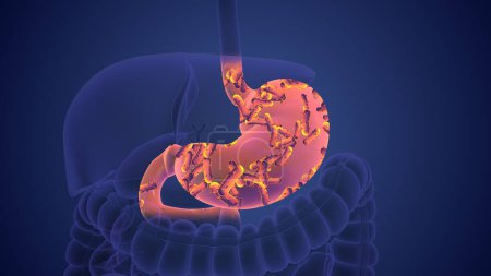 Helicobacter pylori bacteria that Causes Stomach Cancer