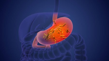 Helicobacter pylori verursacht chronische Entzündungen und Magenkrebs