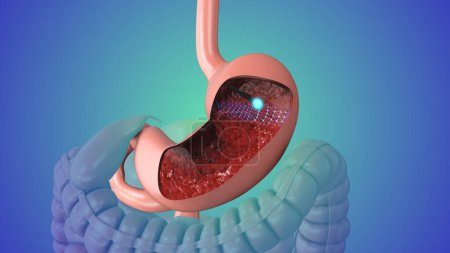 Téléchargez les photos : Endoscopie gastro-intestinale supérieure animation médicale - en image libre de droit