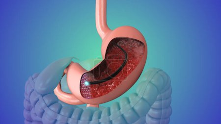 Endoscopia digestiva alta animación médica