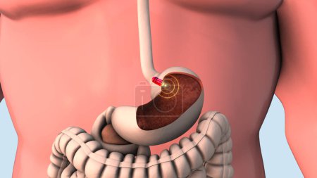 Capsule endoscopy and wireless communication