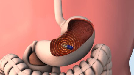 Capsule endoscopy and wireless communication