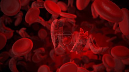 Concepto médico de la anemia falciforme
