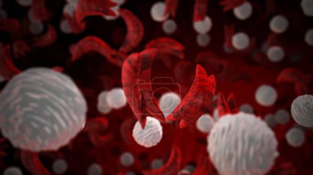 Drépanocytes avec globules blancs concept médical