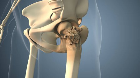 Cancer spreading along a hip bone