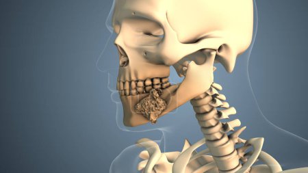 Krebs breitet sich entlang eines Mundknochens aus