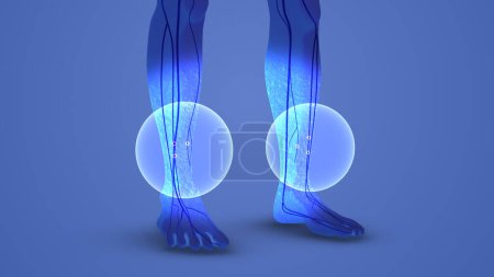 Concepto médico para el entumecimiento del síndrome del túnel carpiano de pies