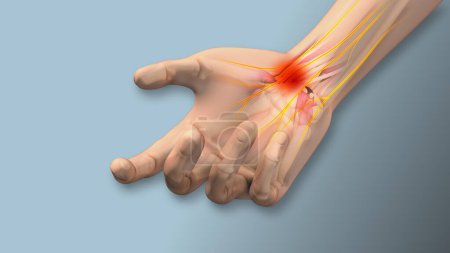 Photo for Carpal tunnel syndrome pain, numbness,tingling - Royalty Free Image
