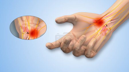 Photo for Carpal tunnel syndrome tingling and numbness in hand - Royalty Free Image