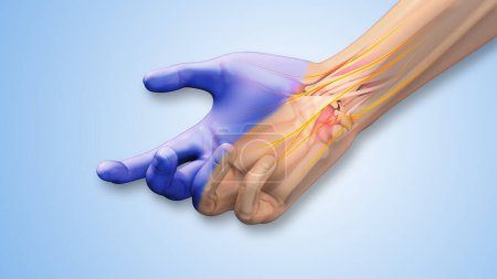 Carpal tunnel syndrome tingling, numbness, and discomfort
