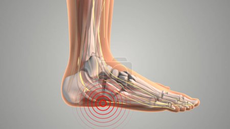 The Tarsal Tunnel Numbness in the Heel and Foot