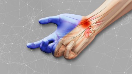 Carpal tunnel syndrome with plexus background