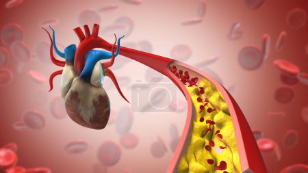 Foto de Placa de colesterol en la arteria que bloquea el flujo sanguíneo - Imagen libre de derechos