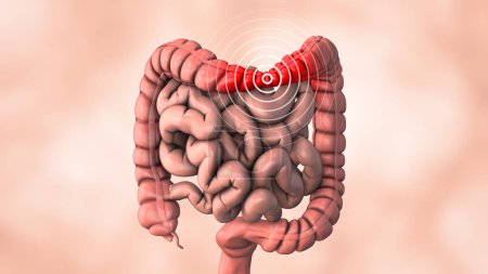 A stomach ache caused by an intestinal condition