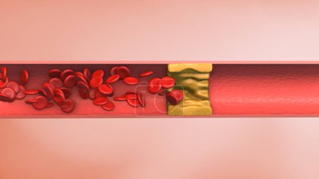 Artery blood clot medical animation