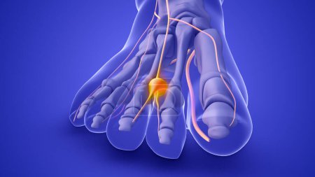 Un neurome de Morton sur un nerf du pied