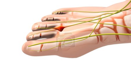 Foto de Neuroma doloroso o nervio pellizcado en el pie - Imagen libre de derechos