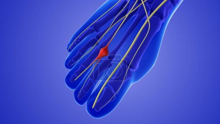 Photo for Medical animation of a neuroma or pinched nerve - Royalty Free Image