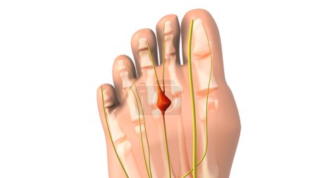 Photo for Pinched nerve or neuroma medical animation - Royalty Free Image