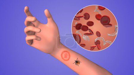 Lyme-Borreliose mit infizierten Blutzellen
