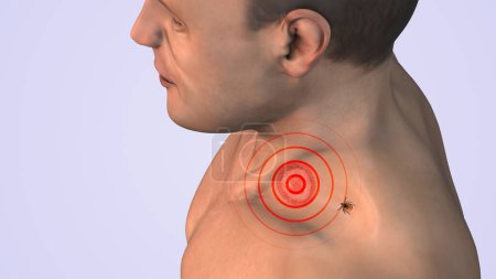 Lyme disease with tick on shoulder neck medical concept