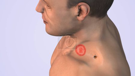 Lyme disease with tick on shoulder neck medical concept