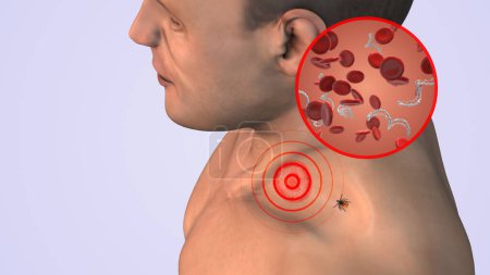 CDC in blood cells with lyme disease on neck