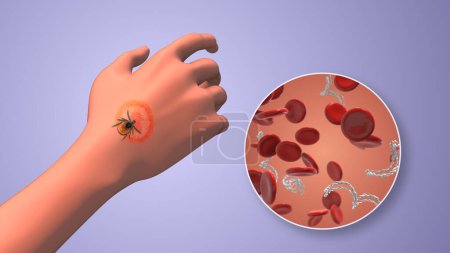 CDC in blood cells with lyme disease on hand